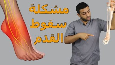 تجربتي مع سقوط القدم